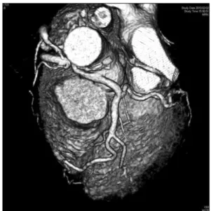 Fig. 2. Schematic review of the operative technique of neo-ostium  formation on the left coronary sinus