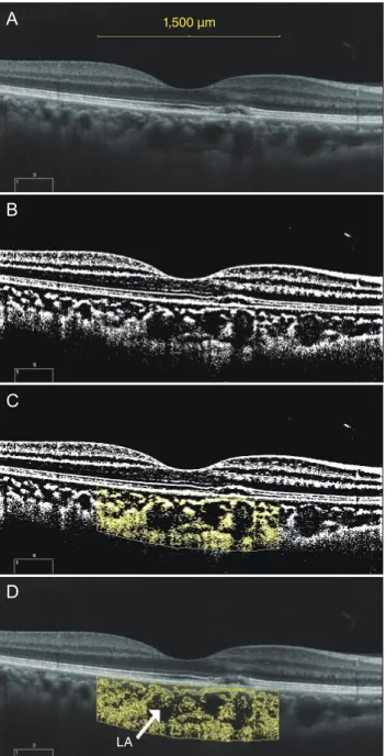Fig. 1. Enhanced depth imaging optical coherence tomography  and processing for converting binary to obtain the choroidal  vascularity index
