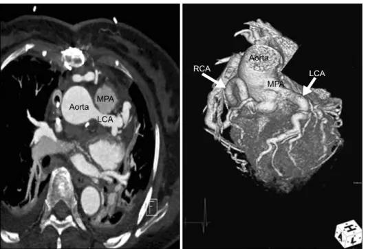 Fig. 3. Postoperative CT shows suc- suc-cessful translocation of the left  coro-nary artery (LCA) to the ascending  aorta
