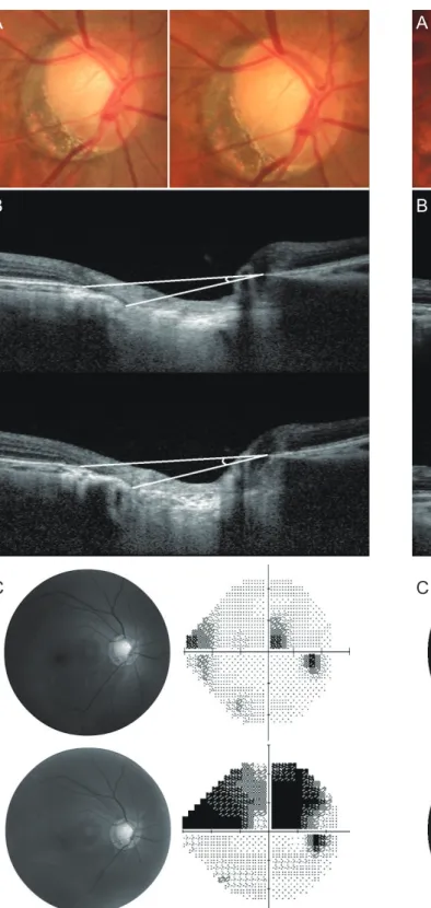 Fig. 4. Representative case example is shown. Upper images  were obtained at baseline examination and lower images were  obtained 52 months later from baseline