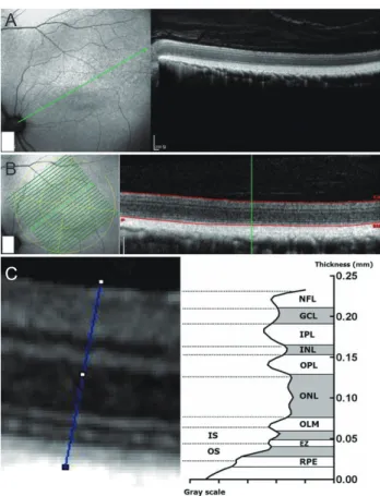 Fig. 1. Optical coherence tomography imaging. Spectralis opti- opti-cal coherence tomography was used to image the area centralis,  where the vessel ends meet