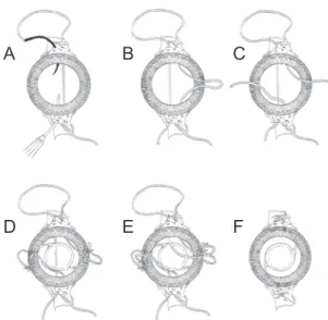 Table 2 shows the postoperative astigmatism according  to surgical method. Postoperatively, total refractive  astig-matism was significantly smaller in the four-point fixation  group; 1.00 ± 0.50 diopters (D) versus 1.80 ± 0.84 D in the Fig