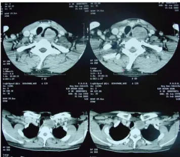 Fig.  2.  Preoperative  esophagogram  shows  a  round  mass  shadow  filling  defect  of  cervical  esophagus.