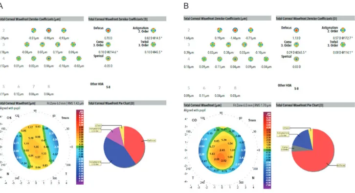 Fig. 4. Changes in corneal aberrations (∆) after sodium hyaluronate (SH) instillation compared to baseline in contact lens wearers