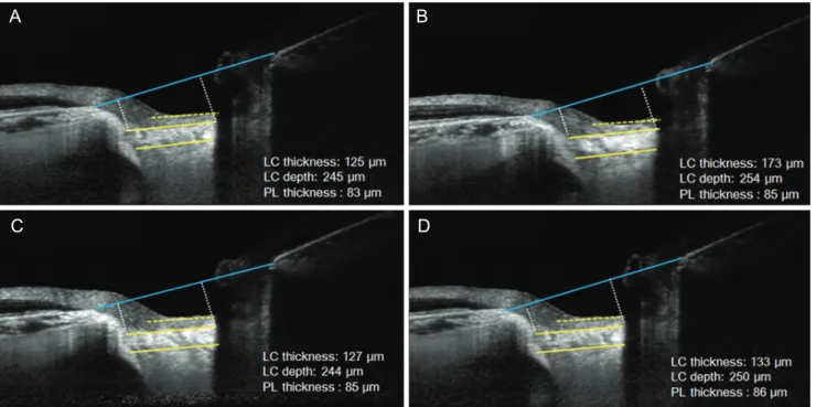 Fig. 3. A representative case. Enhanced depth imaging-optical coherence tomography images of the optic nerve head before and after laser  in situ keratomileusis surgery of a 24-year-old female with -4.5 diopters of spherical equivalent