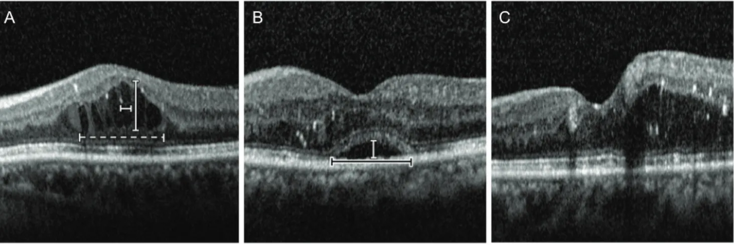 Fig. 1. Patterns of diabetic macular edema observed on optical coherence tomography. (A) Cystoid macular edema type shows prominent  intraretinal fluid (IRF) in the outer nuclear layer
