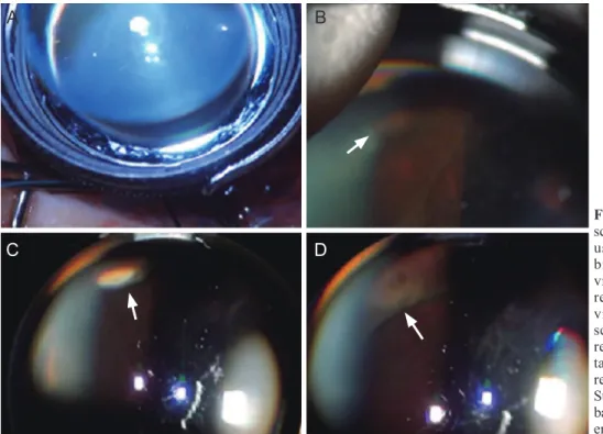 Fig. 1A-1D shows these procedures performed using a slit- slit-lamp illumination system in greater detail.