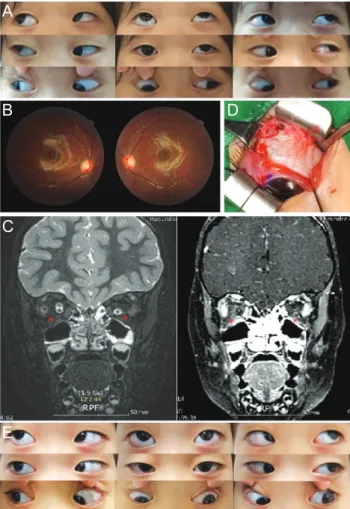 Fig. 1. Preoperative and postoperative clinical presentation of  bilateral inferior rectus muscle absence