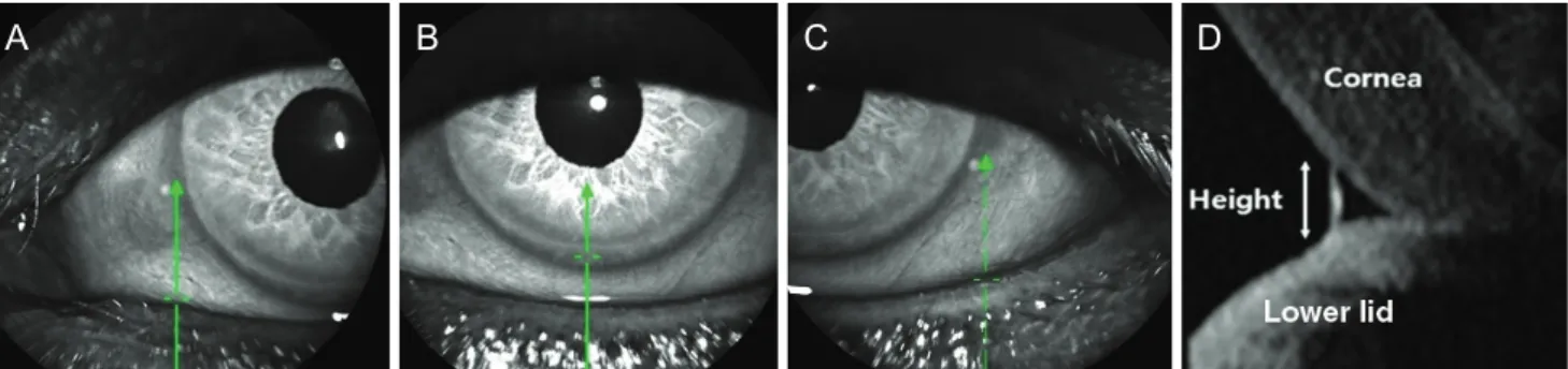 Fig. 2. Measurement of clinical parameters of lower eyelid posi- posi-tion. Marginal reflex distance 2 (MRD 2 ) and marginal nose  dis-tance (MND) were analyzed with ImageJ software.