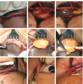 Fig. 3. Surgical procedures used in lower blepharoplasty. (A-C)  The transcutaneous approach
