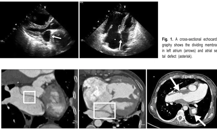 Fig. 1. A cross-sectional echocardio- echocardio-graphy shows the dividing membrane  in left atrium (arrows) and atrial  sep-tal defect (asterisk).
