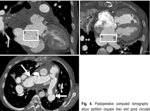 Fig. 4. Postoperative computed tomography shows successful resection of anom- anom-alous partition (square line) and good circulation of pulmonary artery (arrows).