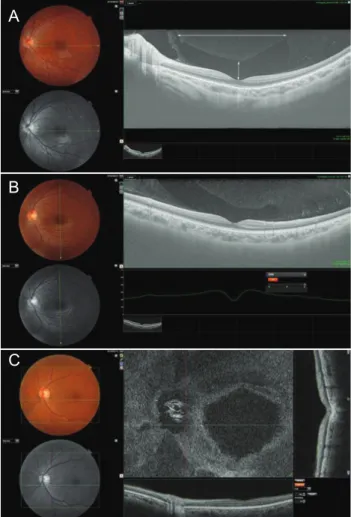 Fig. 1. (A) Twelve-millimetre horizontal line scan centered at the  fovea: the enhanced vitreous visualization function was turned  on, and the vitreous structure is highlighted