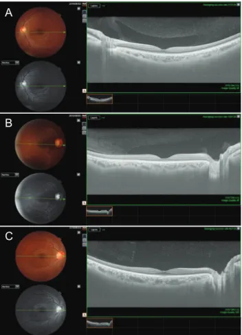 Fig. 2. Representative horizontal cross section images of bursa  premacularis. (A) Boat shape, (B) wedge shape, and (C) irregular  shape.