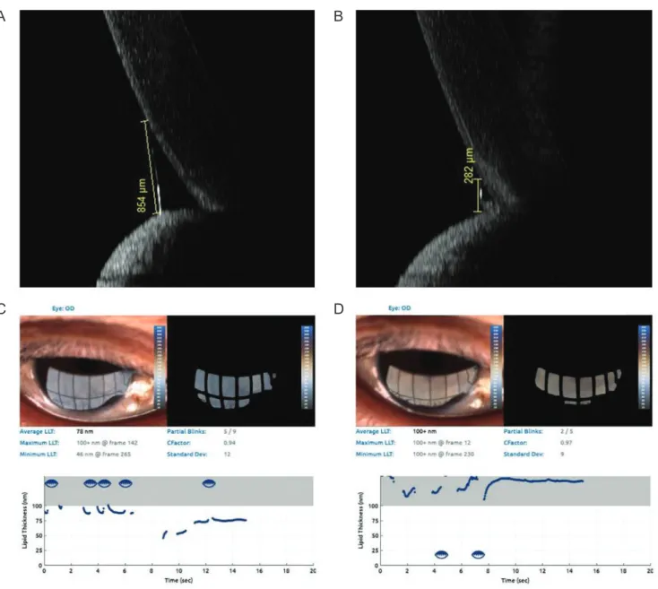 Fig. 1. Tear meniscus height, lipid layer thickness and blinking patterns before and after silicone tube intubation