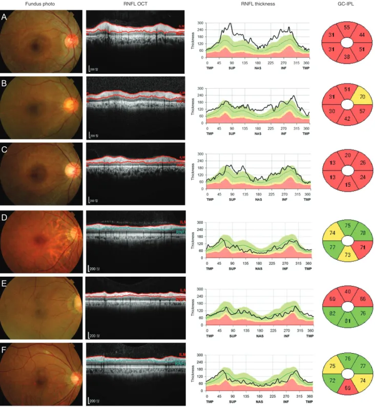 Fig. 3. Six hydroxychloroquine retinopathy patients and their peripapillary retinal nerve fiber layer (RNFL) thickness profiles and ganglion  cell-inner plexiform layer thicknesses