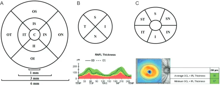 Fig. 1. Macular and optic disc analysis of the right eye. (A) A macular cube 512 × 128 combination scan mode, (B) an optic disc cube 200 ×  200 scan mode, and (C) ganglion cell and inner plexiform layer analysis