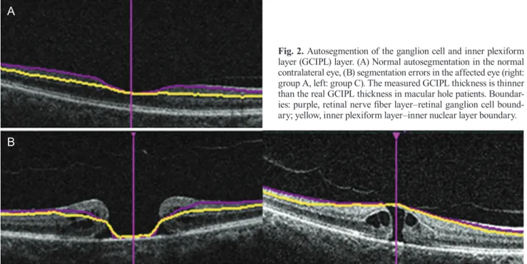 Fig. 2. Autosegmention of the ganglion cell and inner plexiform  layer (GCIPL) layer. (A) Normal autosegmentation in the normal  contralateral eye, (B) segmentation errors in the affected eye (right: 