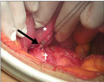 Fig. 2. Endoscopy shows protruding inferior vena cava filter leg  (yellow arrow) in the lumen by penetrating the third portion of  duodenum