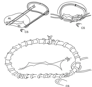 Fig. 1. Tricuspid ring annuloplasty using continuous suture  technique. CS=coronary sinus; SL=septal leaflet; AL=anterior leaflet.