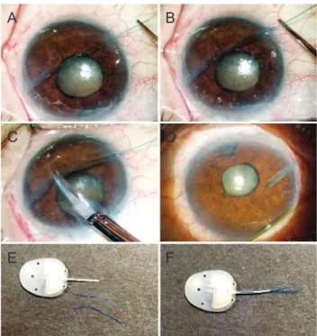 Fig. 1. Anterior segment photographs of (A-C) intraoperative and  (D) postoperative intraluminal stenting of the tube using two 5-0  nylon threads