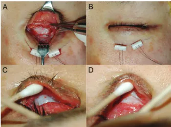 Fig. 1. The surgical procedure using the Permacol implant in  anophthalmic socket reconstruction
