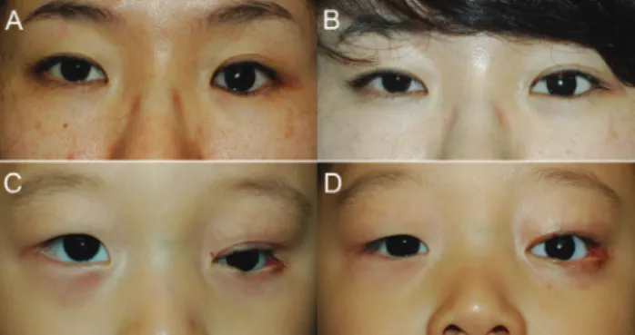 Fig. 2. Representative patients in preoperative (left) and post- post-operative (right) photographs, who underwent reconstructive  surgery with the Permacol graft