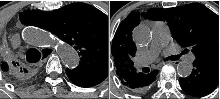 Fig. 1. Preoperative aorta non-contrast computer tomography: an 85-year-old male with severe aortic stenosis and a tuberculosis destroyed  lung