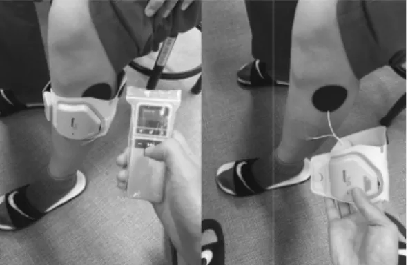 Fig. 2. Functional electrical stimulation 일하게 하였으나 기능적 전기자극과 리듬청각의 유무 가 달랐다. 대조군은 리듬청각자극이 아닌 음악이 나오 는 이어폰을 착용하고 기능적 전기자극이 없는 상태에 서 보행훈련을 실시하였다