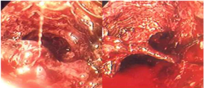 Fig. 1. Gasrofiberscopy showing the endoesophageal stent, edematous and necrotic esophageal mucosa, and blood clots located at 32cm from incisor.