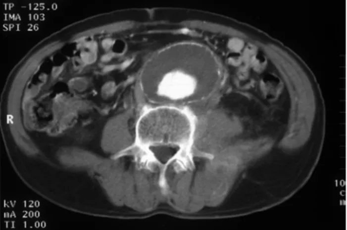 Fig.  2.  Abdominal  aorta,  Right  external  iliac,  Left  femoral  artery  anastomosis  &amp;  femoro  femoral  bypass.