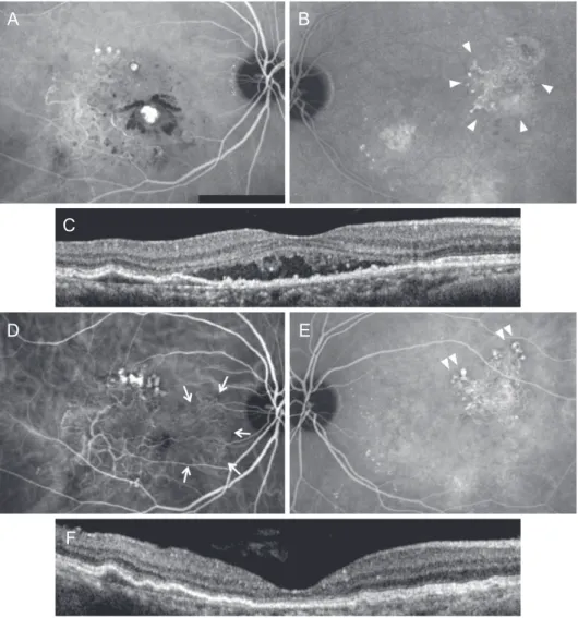 Fig. 3. A representative case of polypoidal choroidal vasculopathy (PCV) with feeder vessels