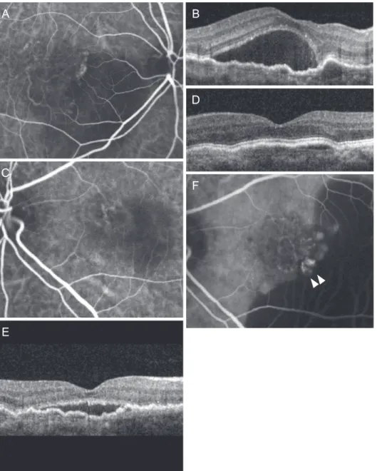 Fig. 4. A representative case of polypoidal choroidal vasculopathy with feeder vessels