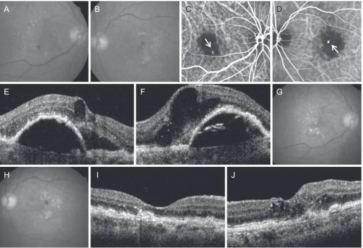Fig. 1. A representative case showing treatment outcome of bilateral retinal angiomatous proliferation