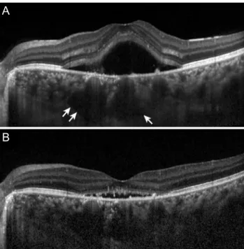 Fig. 2. Optical coherence tomography images in enhanced depth  image mode of a patient who was diagnosed with central serous  chorioretinopathy at gestational age 25 weeks
