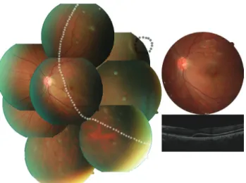 Fig. 1. Age of patients with rhegmatogenous retinal detachment. 