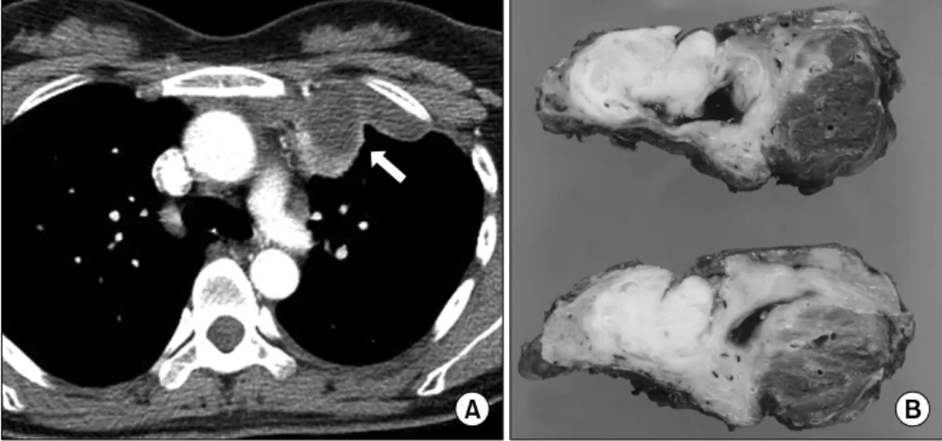 Fig. 2. Microscopic findings of the solid portion revealed a normal  acinar structure and islets of the pancreas (H&amp;E, ×200).