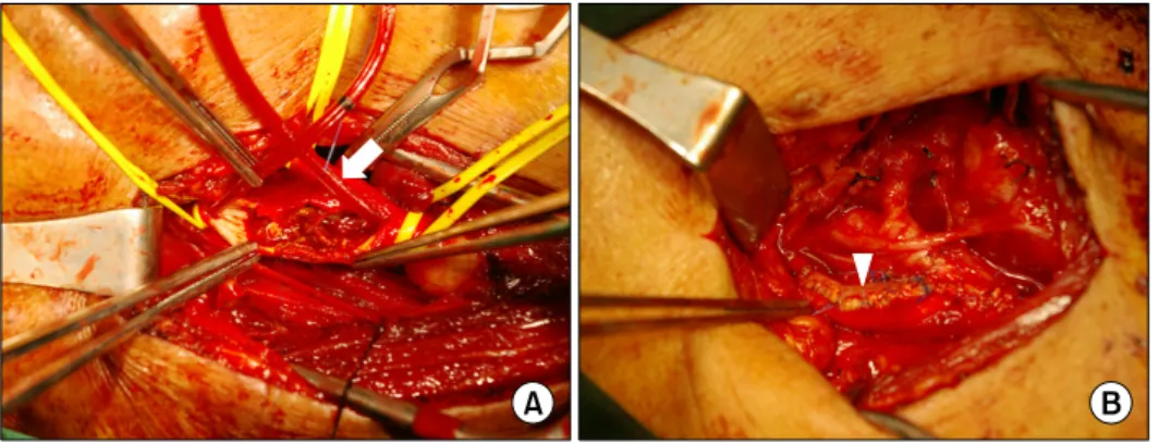Fig. 2. Operative view. (A) A shunt  (white arrow) was placed to maintain  cerebral flow during carotid  endarte-rectomy