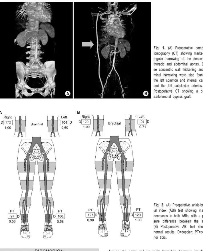 Fig. 1. (A) Preoperative computed  tomography (CT) showing marked  ir-regular narrowing of the descending  thoracic and abdominal aortas