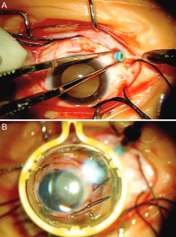 Fig. 1. (A) A 25-gauge chandelier was inserted into the infero- infero-temporal quadrant after isolation of the rectus muscle