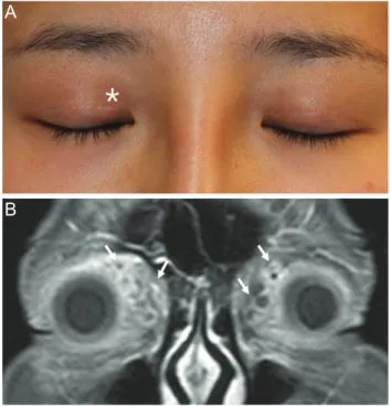 Fig. 1. (A) A 29-year-old woman presenting with a 3-month his- his-tory of palpable mass in the right upper eyelid (asterisk) that  de-veloped 10 months after an injection of cryopreserved autologous  fat into her face