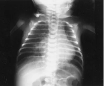 Fig.  2.  Preoperative  2D  echocardiogram.  The  arrows  indicates  a  large  aortopulmonary  window  in  the  parasternal  short  axis  view