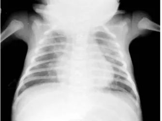 Fig.  6.  Postoperative  chest  roentgenogram  8month  after  operation. 맥  감자를  제거하였다