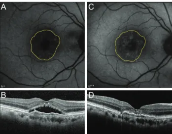 Fig. 3. Changes in fundus autofluorescence and spectral domain  optical coherence tomography (SD-OCT) after intravitreal  an-ti-vascular endothelial growth factor injection in an exudative  age-related macular degeneration patient with type 1 choroidal  ne