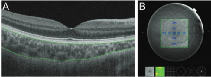 Fig. 1. Choroidal thickness map obtained using swept-source  optical coherence tomography in a healthy 9-year-old girl