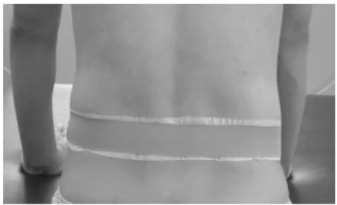 Fig 1. Lumbar stabilizing taping