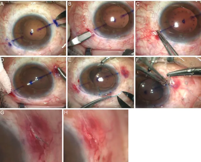 Fig. 1. Intrascleral pocket technique. (A,B) Two points were marked at 180° apart at the limbus