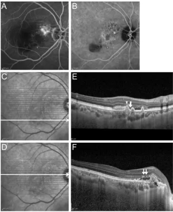 Fig. 2. Representative angiography and optical coherence tomog- tomog-raphy images in an eye diagnosed with polypoidal choroidal  vas-culopathy
