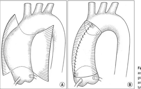 Fig. 1. Wrapping of the ascending  aorta with the Dacron graft. The  graft is pulled below the aorta (A)  and oversewn with a continuous  su-ture (B).