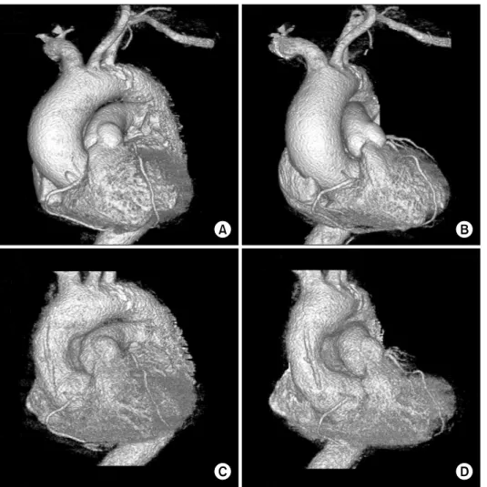 Fig. 2. Preoperative computed tomo- tomo-graphic scan (A, B). Postoperative  computed tomographic scan (C, D)  of the same patient showing a  de-crease in the diameter of the  as-cending aorta.